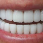 Реставрация зубов: художественная реставрация зубов