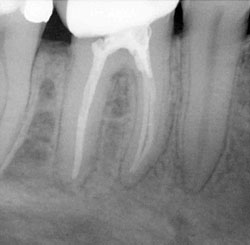 Лечение корня зуба при кариесе