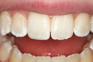 Результат реставрации переднего зуба после скола