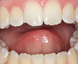 Скол на передних зубах