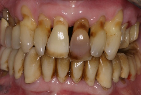 Почернение зубов