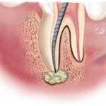 Гранулема зуба: симптомы и лечение гранулемы