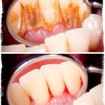 Кровоточат десны при чистке зубов — лечение