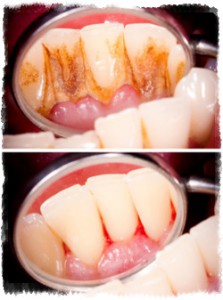 Кровоточат десны после чистки зубов