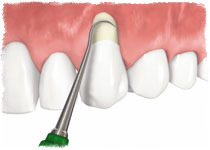 Причины оголения шейки зуба