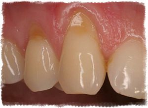 Причины оголения шейки зуба и лечение в домашних условиях