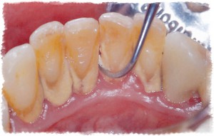Удаление зубного камня при лечении против кровотечения десен