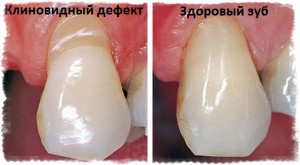 Разница между здоровым зубом и зубом с клиновидным дефектом