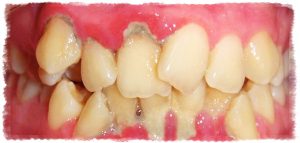Неправильная окллюзия - противопоказание к имплантации зубов