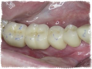 Имплантация зубов - эстетично