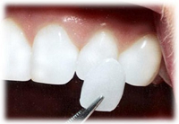 Виды зубных пломб