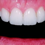 Прямая реставрация передних зубов