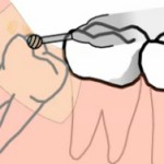 Удаление зуба мудрости на нижней челюсти
