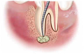 Симптомы гранулемы зуба
