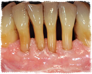 Лечение оголения шейки зуба