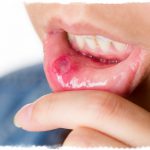 Чем лечить стоматит у взрослых во рту