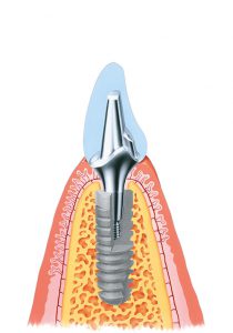 Структура зубного имплантата