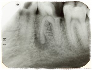 Зубная боль при периодонтите