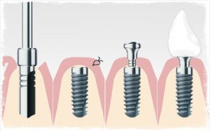 Как происходит имплантация зубов