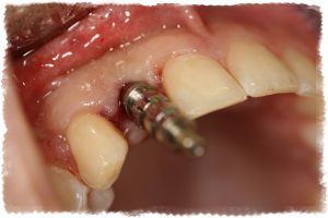 Показания для имплантации зубов