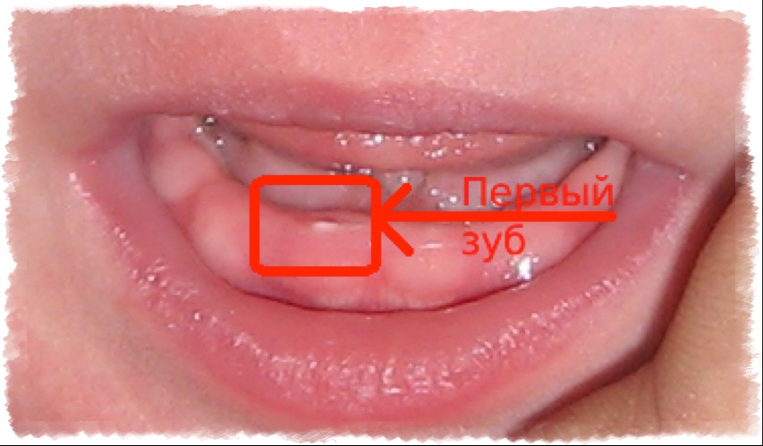 Прорезывание зубов у детей: фото десны